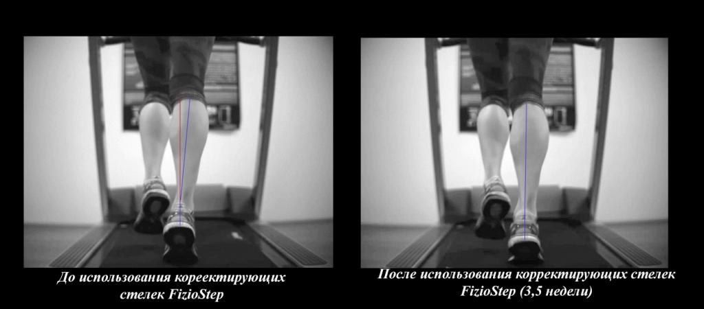 Франшиза FizioStep - анатомические стельки