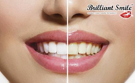 Франшиза Brilliant Smile - косметическое отбеливание зубов